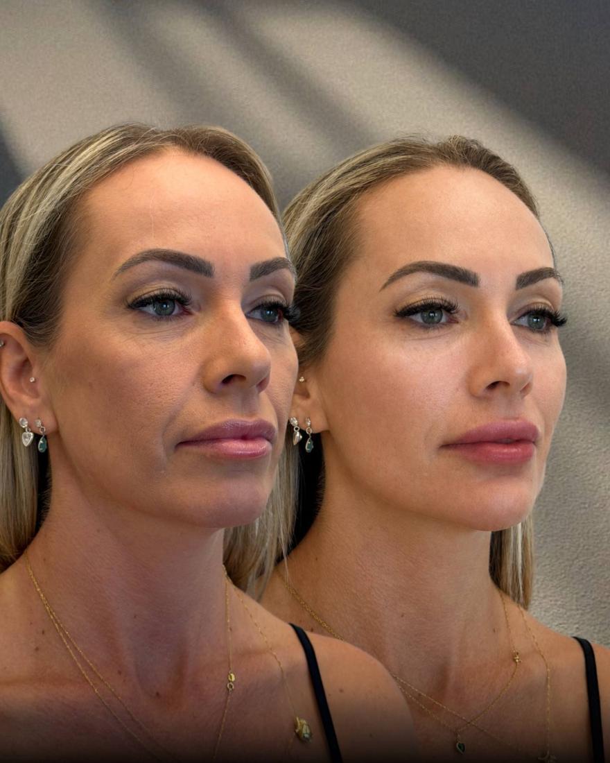 Resultado de harmonização facial — Mais Beauté